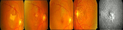 Age-related Macular Degeneration